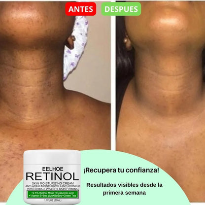 CREMA DESPIGMENTANTE DE RETINOL