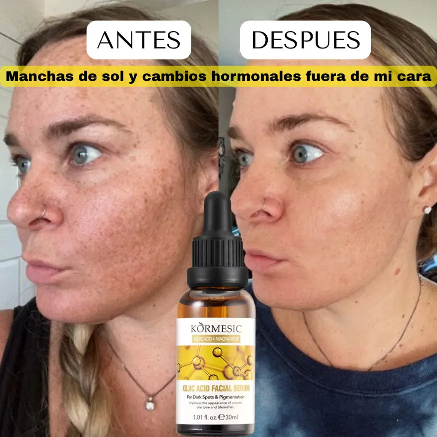 SERUM DESPIGMENTANTE E HIDRATANTE DE NIACINAMIDA Y ACIDO KOJICO