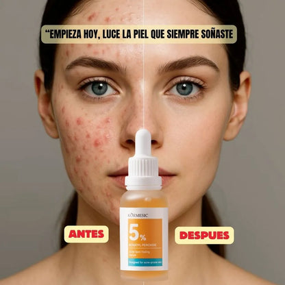 SERUM  ACLARANTE DE MANCHAS DE ACNE