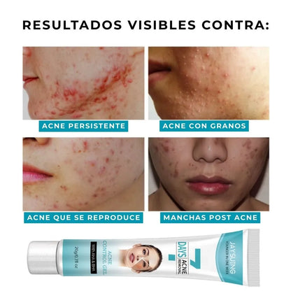 Gel anti acné y manchas