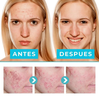 Gel anti acné y manchas