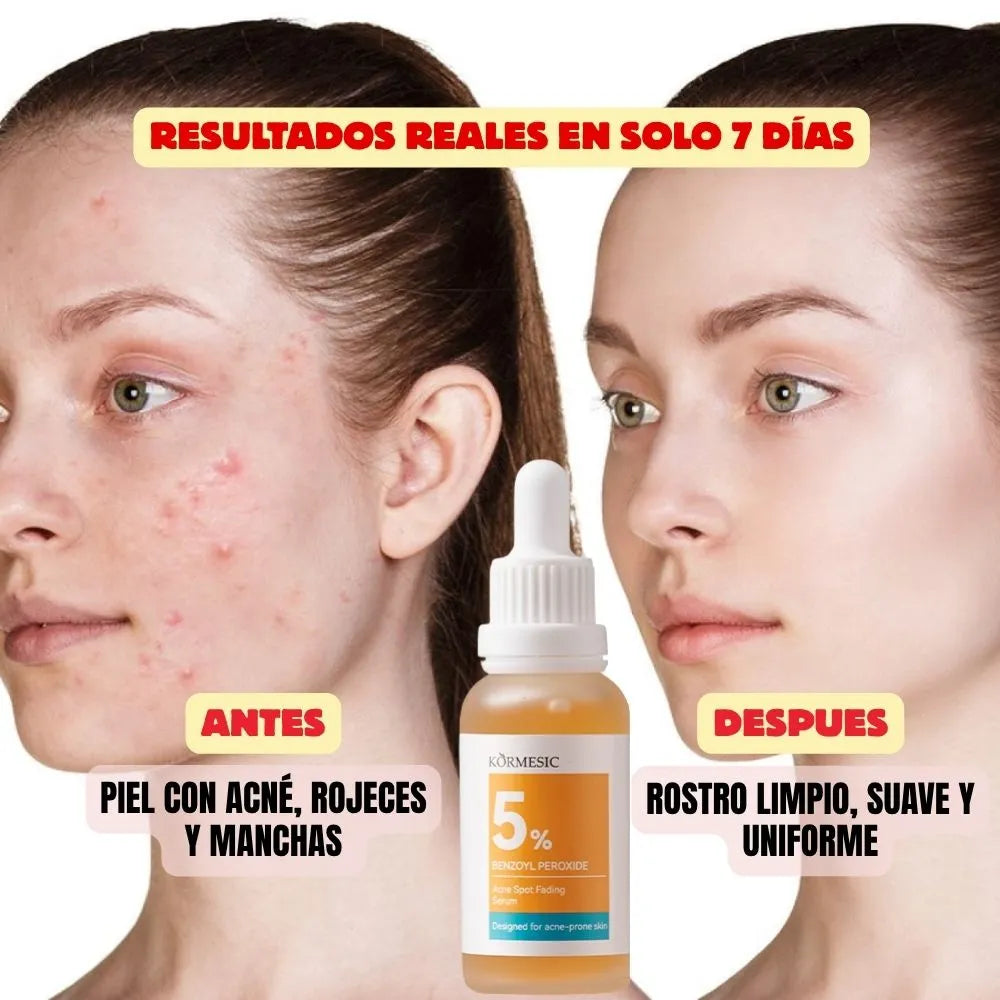 SERUM  ACLARANTE DE MANCHAS DE ACNE