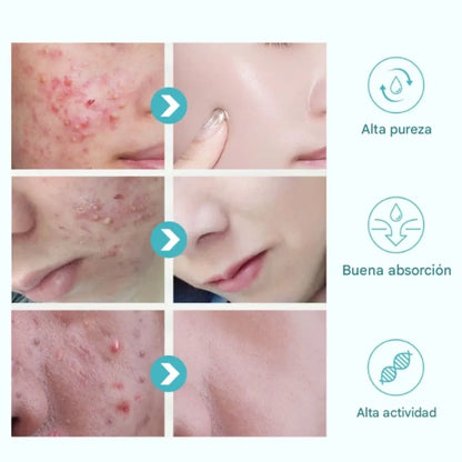 Gel anti acné y manchas