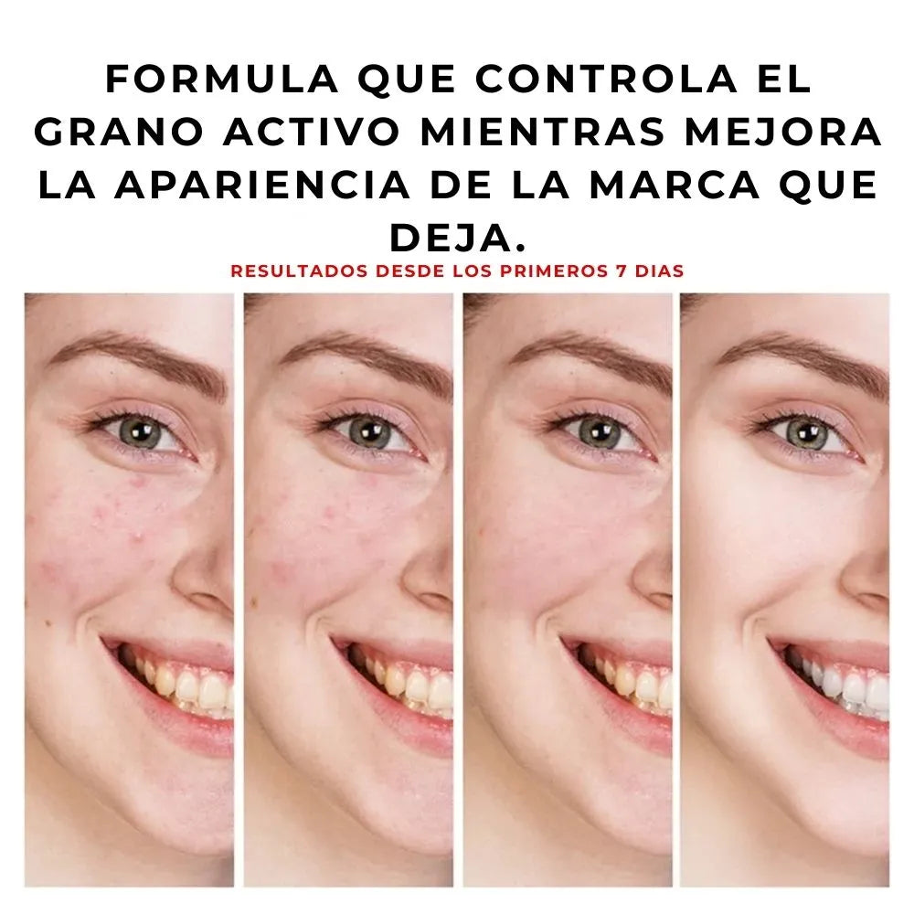 Gel anti acné y manchas