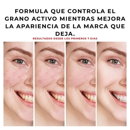 Gel anti acné y manchas